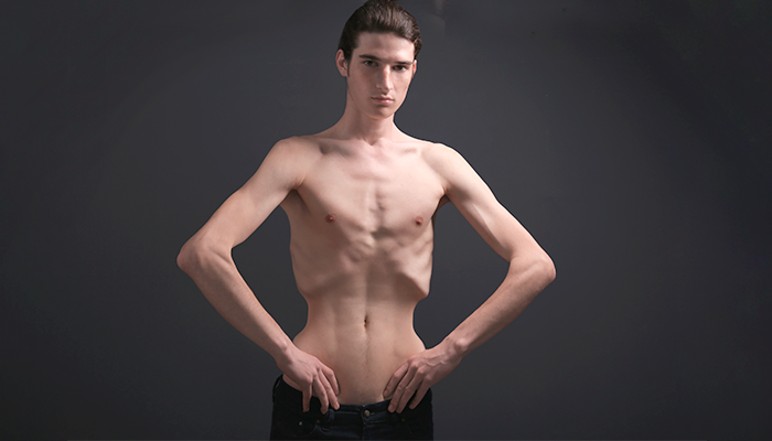 Fotografía para artículo sobre los síntomas de la anorexia y cómo tratarla, para el blog de topfarma.